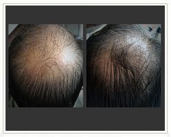 Slider image (5) Giovanni Bojanini | Alopecia Hair Loss Center